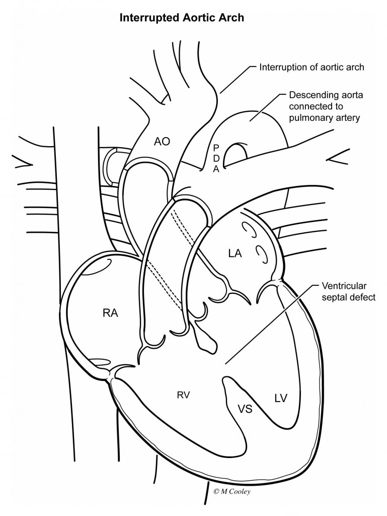 CD-14- interrupted aortic arch