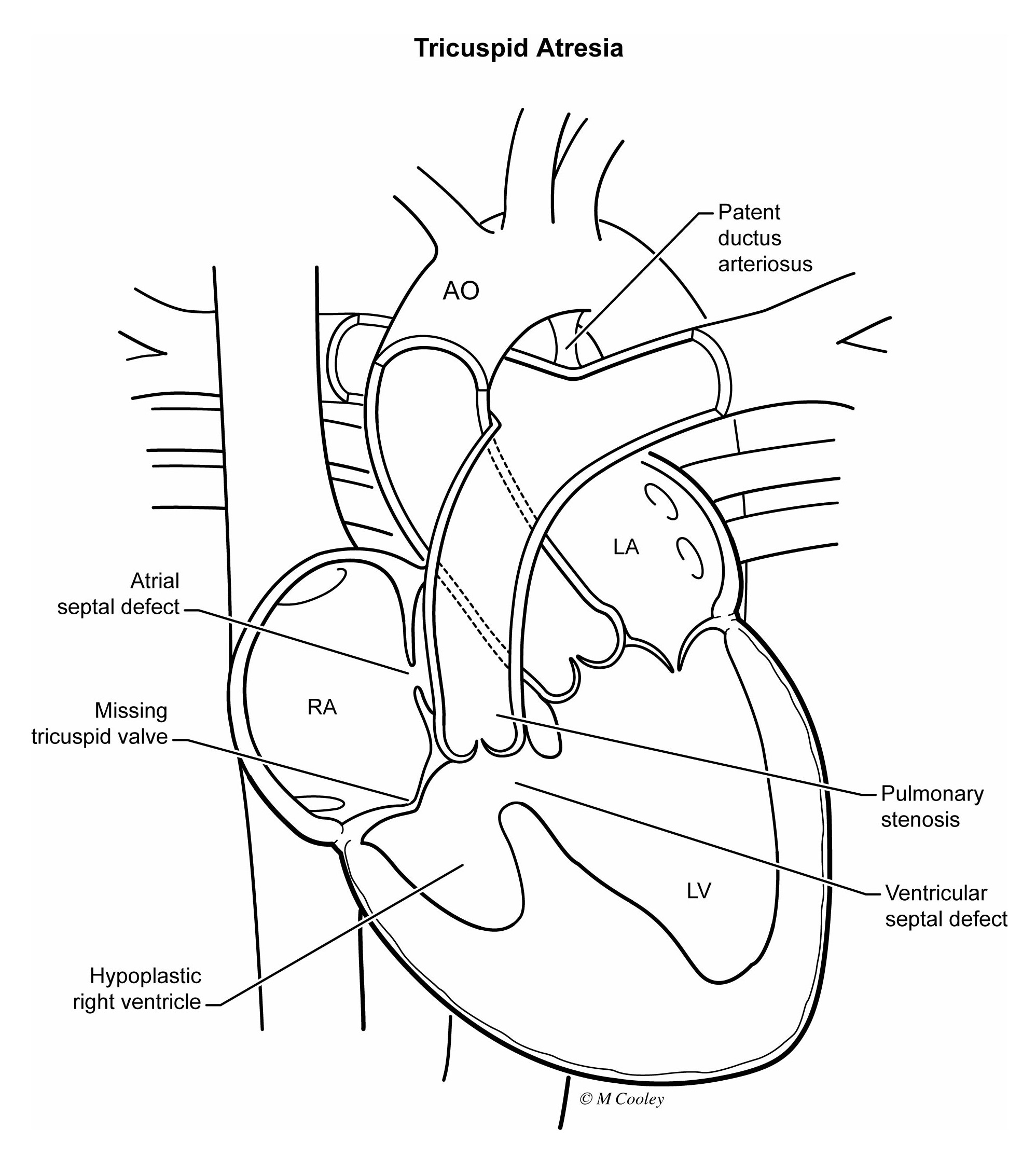 Congenital Heart Defects – Ohio Fetal Medicine Collaborative