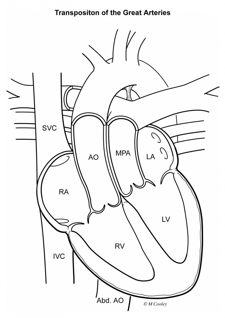 CD-5- transposition of the great arteries