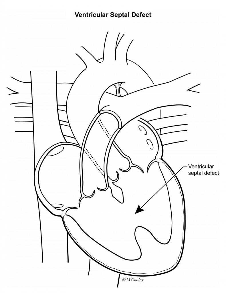 CD-6- ventricular septal defect