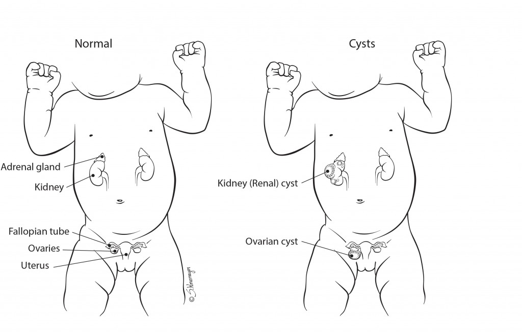 abdominal_cysts_2_labels