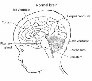 Agenesis Of The Corpus Callosum – Ohio Fetal Medicine Collaborative