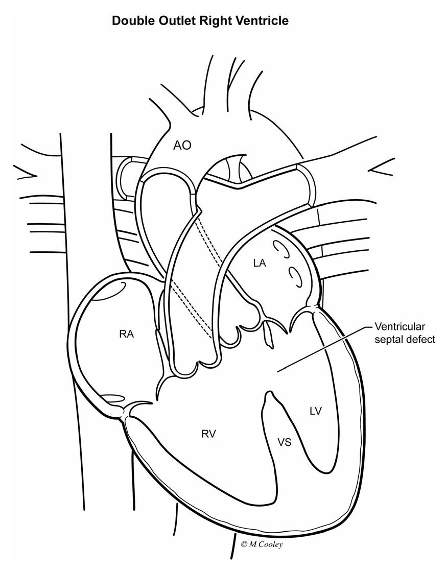 Congenital Heart Defects – Ohio Fetal Medicine Collaborative